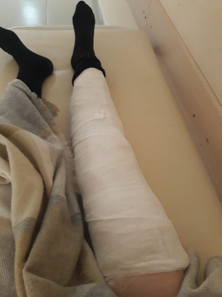 Golden Crush Story Of Broken Leg (9 photos)